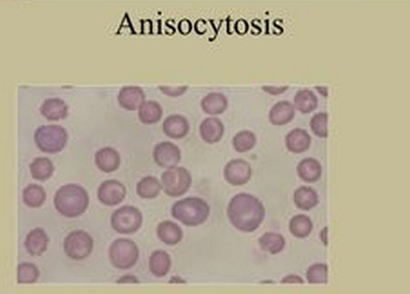 Anisocytosis