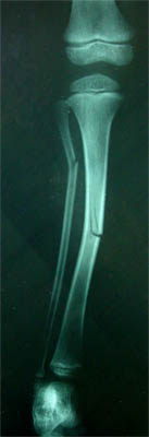 greenstick fracture tibia