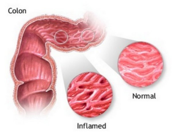 Inflamed Colon - Symptoms, Causes and Treatment - (2018 - Updated)