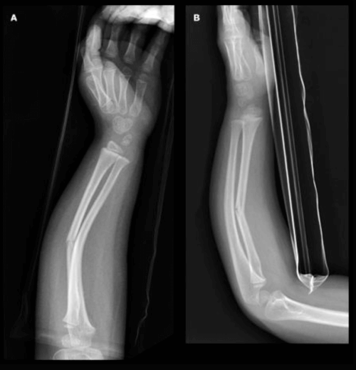 Greenstick Fracture - Definition, Causes and Treatment