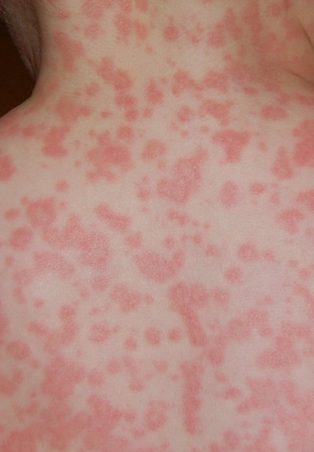 A severe amoxicillin rash at the back and upper parts of the body.figure