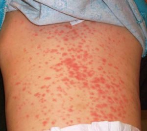 Normal Amoxicillin Rash Amoxicillin Rash - Pictures, How long does it last, Treatment