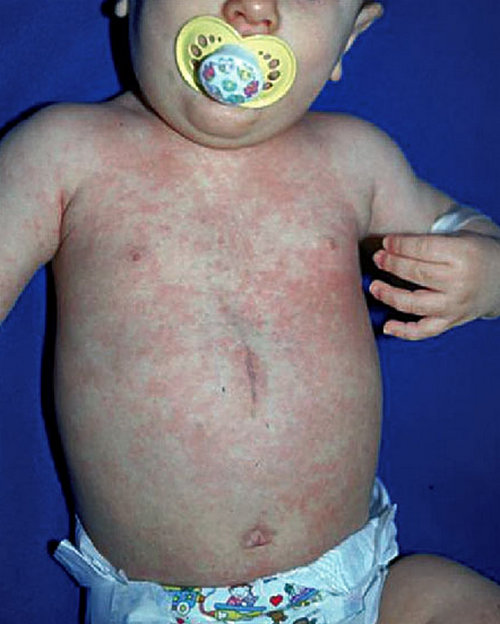 a baby with roseola rash in the chest and abdomen.image