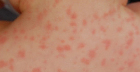 amoxicillin rash.image