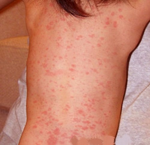 Roseola Rash - Pictures (Photos, Images), Causes, Treatment