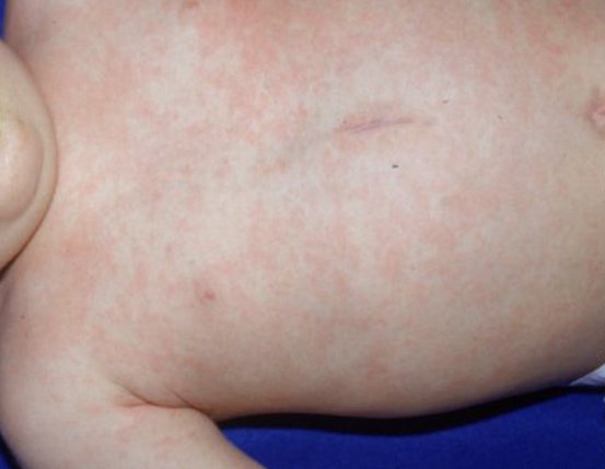 Roseola Rash - Pictures (Photos, Images), Causes, Treatment