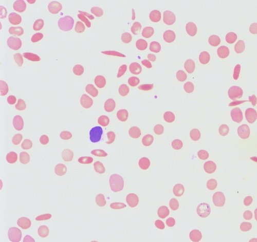 RDW (red blood cell distribution width linked with peripheral smear).image