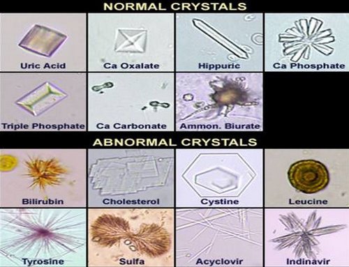 A chart with images of crystals normally found in the urine as well as those abnormally found in urine.photo