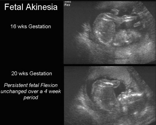 A radiologic view of fetal akinesia.photo