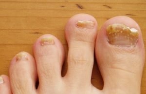 Brittle toenails, crumbling edges, and yellowish discoloration of the ...