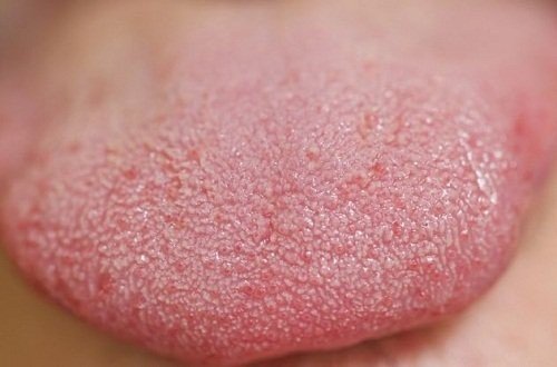 Red spots on the tongue, which causes pain, itching, and inflammation.photo