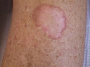 A clinical manifestation of porokeratosis of mibelli.image