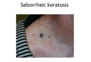 Seborrheic keratosis or melanoma in an elderly patient.image