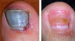 A bruised and severely infected toenail.image