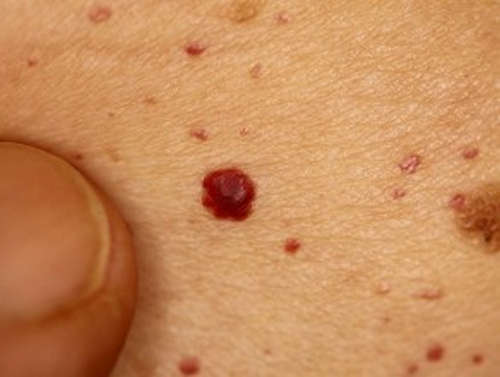 A reddish to brownish spot medically called angiokeratoma image photo picture