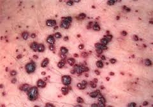 Angiokeratoma can be extremely unsightly and warrants immediate removal image photo picture