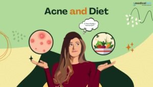 Acne and Diet Is There Really a Connection