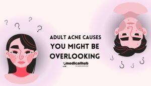 Adult Acne Causes You Might Be Overlooking