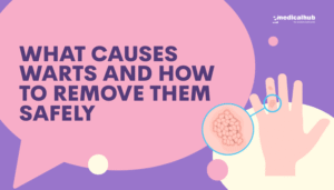 What Causes Warts and How to Remove Them Safely